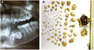 A) Odontoma compuesto de premolares inferiores. B) Imagen macroscópica de odontoma compuesto, constituido por una cápsula de tejido fibroso y múltiples dentículos.