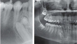 A) Proyección periapical de odontoma complejo. B) Odontoma complejo en zona de premolares inferiores (ortopantomografía).