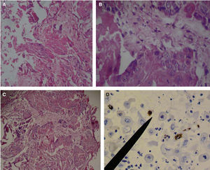 Histological pictures of OSCC with H&E. A) 10x objective, epithelial dysplasia with connective anaplasia can be observed. B) 40x objective: keratinocytes with euchromatic, poikylocariotic nuclei, with megacariotic predominance; telophasic mitotic shape is observed. C) 40x objective: conspicuous conjunctive tissue with epithelial cell infiltrate is observed, megacariotic, euchromatic, poikylocariotic. D) 40x objective, the marker shows mild positive immunohistochemistry for K-667 in keratinocytes infiltrated en lamina propria, and negative for cyclin D1.