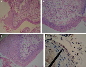 Histological pictures of OSCC with H&E. A) 10x objective shows non keratinized, stratified flat lingual epithelium with hyperplastic foci at the expense of the spinous stratum, alternating with highly dysplastic tissue foci. B) 40x objective reveals in the lamina propria abundant basophilic nuclei predominantly rounded and ovoid shaped, megakariotic and euchromatic, alternating with spaces coated with cells of epithelioid aspect compatible with blood vessels. C) 40x objective reveals lamina propria infiltrated with poly-segmented, heterochromatic nuclear shapes, polymorphonuclear compatible over fabric de eosinophilic thin fibers compatible with reticular fibers. D) 40x objective. The marker shows mildly positive immunohistochemistry for cyclin D1 in spinous stratum keratinocytes, and negative to Ki-67.