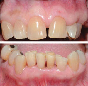 Upper and lower front view one month after treatment. Full resolution of gingival enlargement.