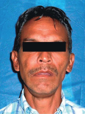 Frontal clinical photograph showing facial asymmetry, at the expense of the left half of the face, with presence of labial incompetence.