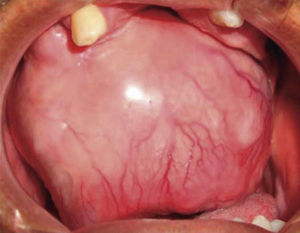 Intra-oral clinical photograph showing a tumor lesion measuring approximately 9 × 9cm long, occupying a large section of the oral cavity.