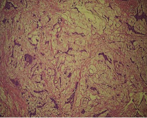 Histopathological study with hematoxilin and eosin displaying ductal elements imbibed in a myxoid stroma.