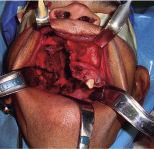 Intra-oral clinical photograph displaying surgical bed after a type II B Brown maxillectomy, generating oralantral-nasal communication.