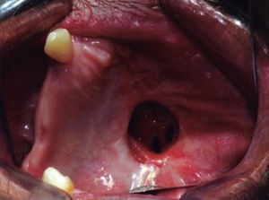Intraoral clinical photograph of 10 month postoperative control showing tissue formation and oralnasal fistula in the palate region.