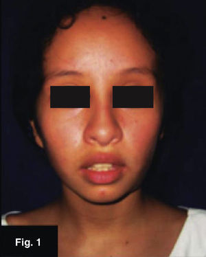 Eleven year old female patient, case 1.