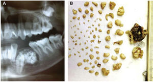 A) Compound odontoma in lower premolars. B) Macroscopic image of compound odontoma constituted by a capsule of fibrous tissue and multiple denticles.