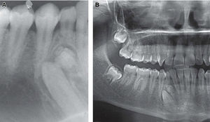 A) Periapical projection of complex odontoma. B) Complex odontoma in the area of lower premolars (orthopantomography).