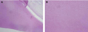 A) Histopathology of compound odontoma characterized by the presence of dental tissues arranged in an organized manner, dentin and pulp. B) Dentin (400x).