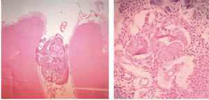 Histopathology of complex odontoma, disorganized mass of dentin-like material and enamel prisms.