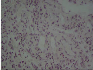 Corte histológico donde se observa tejido de granulación evidenciado por la presencia de múltiples vasos neoformados, fibroblastos e infiltrado inflamatorio crónico. H-E. 10x.