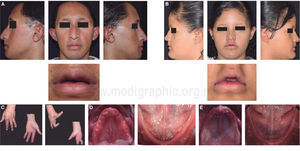 Características clínicas de los pacientes. (A y B) Rasgos faciales característicos de pacientes con displasia. C) Sindactilia presentada por el paciente varón. (D y E) Fotografías intraorales que muestran el estado de descentración total.