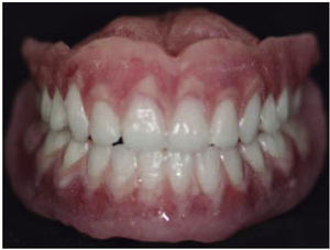 Una de las dentaduras ya procesadas en las cuales se puede observar el caracterizado.