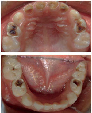 Condiciones iniciales de la cavidad bucal del paciente, motivo por el cual se decidió intervenir bajo anestesia general.