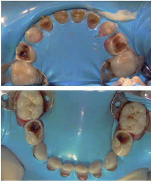 Totalidad de los órganos dentarios aislados al momento de la intervención bajo anestesia general.