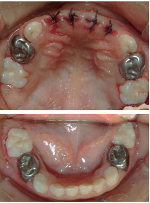 Características de los dientes una vez concluida la rehabilitación.
