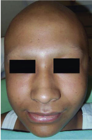 Manifestaciones producidas por el efecto de la quimioterapia en un paciente con leucemia. Nótese la palidez de los tegumentos y el efluvio anágeno caracterizado por la pérdida absoluta de pelo y cejas.