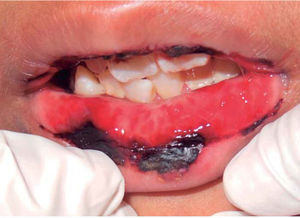 Mucositis oral a consecuencia de la administración de metotrexato en un paciente de ocho años de edad con leucemia.