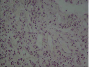 Histological section revealing granulation tissue evidenced by presence of multiple neo-formed vessels, fibroblasts as well as chronic inflammatory infiltrate. H-E 10x.
