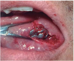 Intraoral photograph: removal of bullet in the tongue.