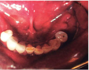 Control of intraoral wound.