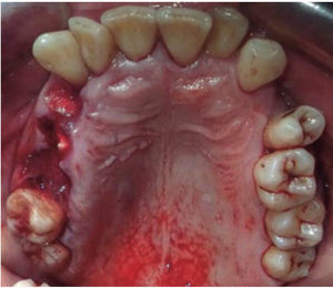 Occlusal photograph, dental fractures.