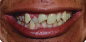 Aspecto inicial con fractura del 11, agrandamiento gingival en el 12 y cicatriz en el labio inferior.
