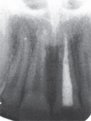 Radiografía dentoalveolar inicial con tratamiento de sistema de conductos.