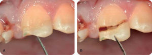 Fractura complicada de corona del diente 21.
