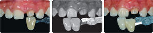 A) Registro de color del muñón. B) En blanco y negro para apreciar el valor de los dientes contiguos. C) Color y características del diente homólogo.