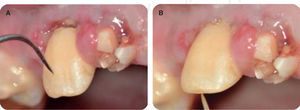 Fractura complicada de corona del diente 12 a nivel cervical.