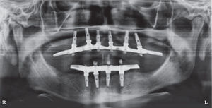 Prótesis implanto soportada instalada en ambos maxilares.