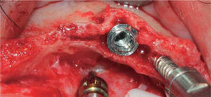 Implante de 3.75mm de diámetro colocado antes de remover el expansor óseo en distal.