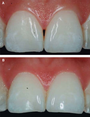 Comparación de papila interdental. A) Papila inicia antes de las infiltraciones de AH. B) Papila al finalizar las cuatro infiltraciones de AH. Fuente Directa.
