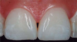 Pérdida de la papila interdental. Fuente Directa.