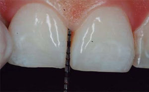 Al realizar el sondeo contamos con 5mm desde la cresta ósea hasta el punto de contacto. Fuente Directa.