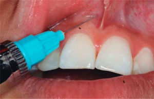 Anestesia de la zona. Fuente Directa.