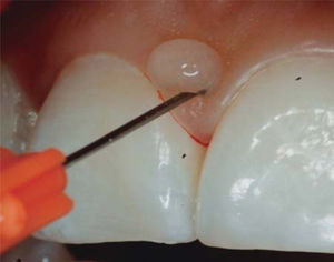 Colocación de AH. Fuente Directa.