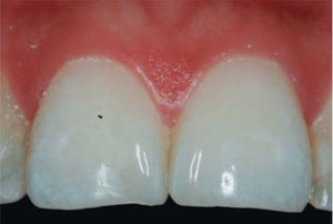 Se observa el crecimiento de la papila interdental. Fuente Directa.