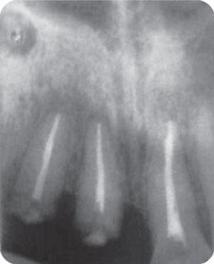 Completed root canal system treatment.