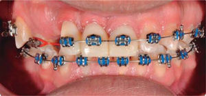Telio Lab provisional teeth.