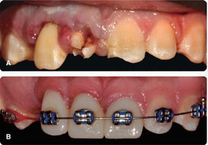 A) Initial 48hours after TDI. B) Final with orthodontic treatment.