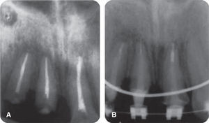 A) X-ray of root canal system treatment. B) X-ray after orthodontic treatment initiation.