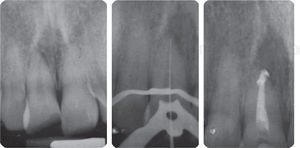 Root canal system treatment.