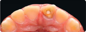 Initial occlusal aspect, access to chamber is observed.