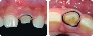 Double-thread gingival separation in order to make occlusal impression of fiber glass postcementation and thread.