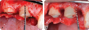 Osteoplasty in crown lengthening.