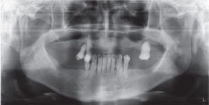 Generalized horizontal bone resorption and bilateral maxillary sinuses pneumatization.