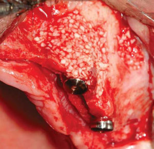 Bovine xenograft placed in the vestibular area of all implants.
